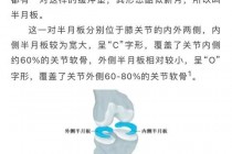 半月板撕裂手术费用解析：价格因素及医院选择指南