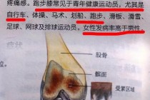 跑步VS走路_膝关节损伤程度对比与健康影响解析